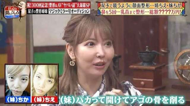 「乳輪をレーザーで焼いて皮膚を剥がした」「肋軟骨を取って鼻に移植」…総額4000万円!双子整形モデルが体験した“壮絶手術”