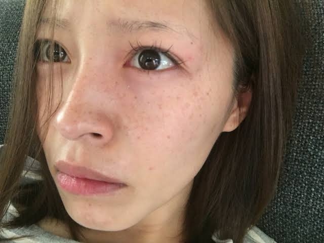 シミ取り後のスキンケア