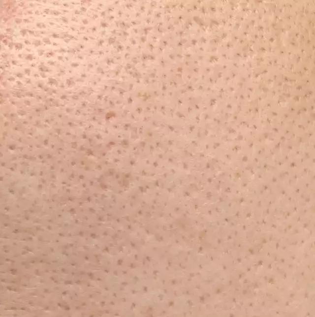 肌の汚い人のファンデーション