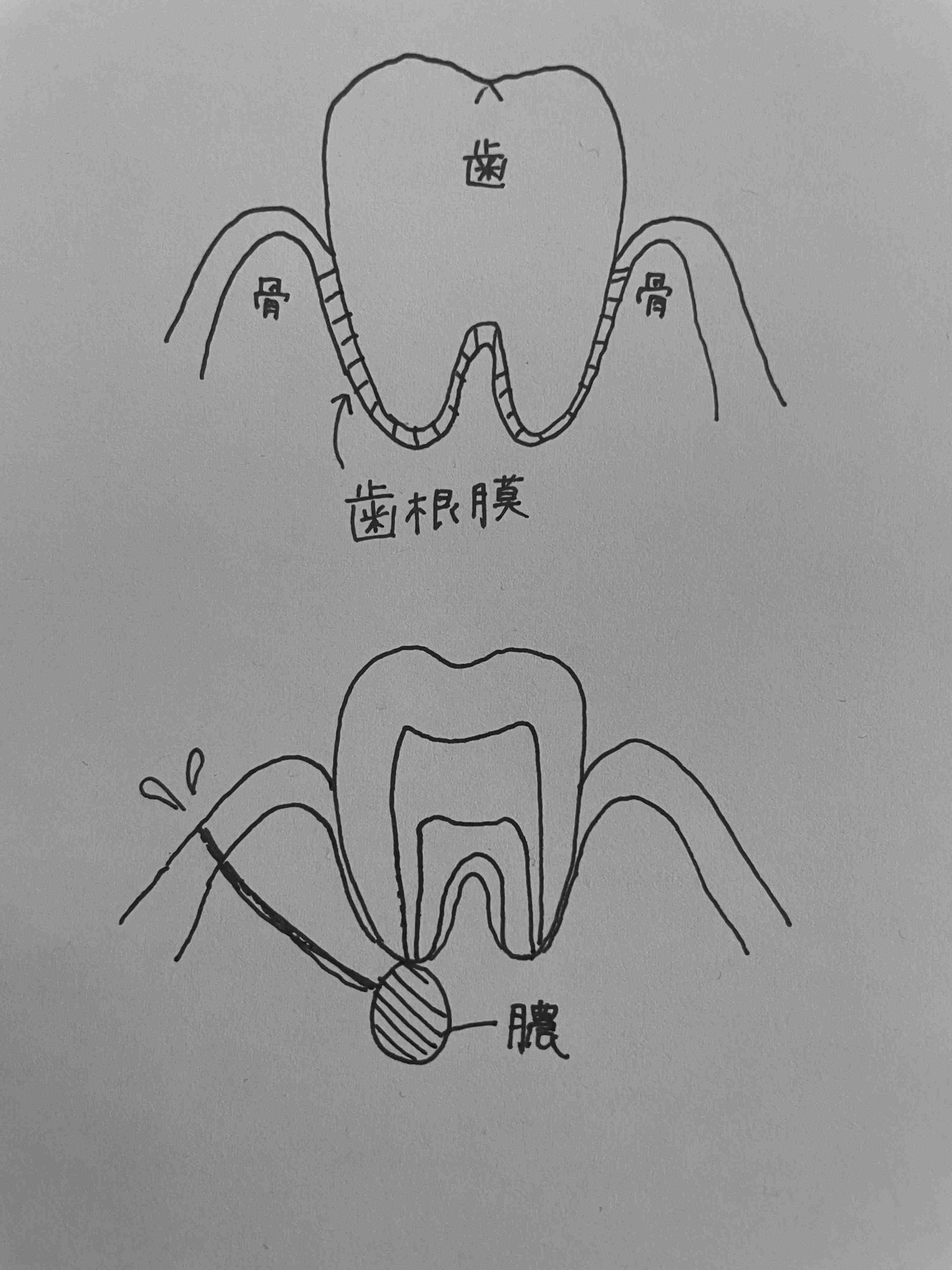 歯根膜炎になった事がある人