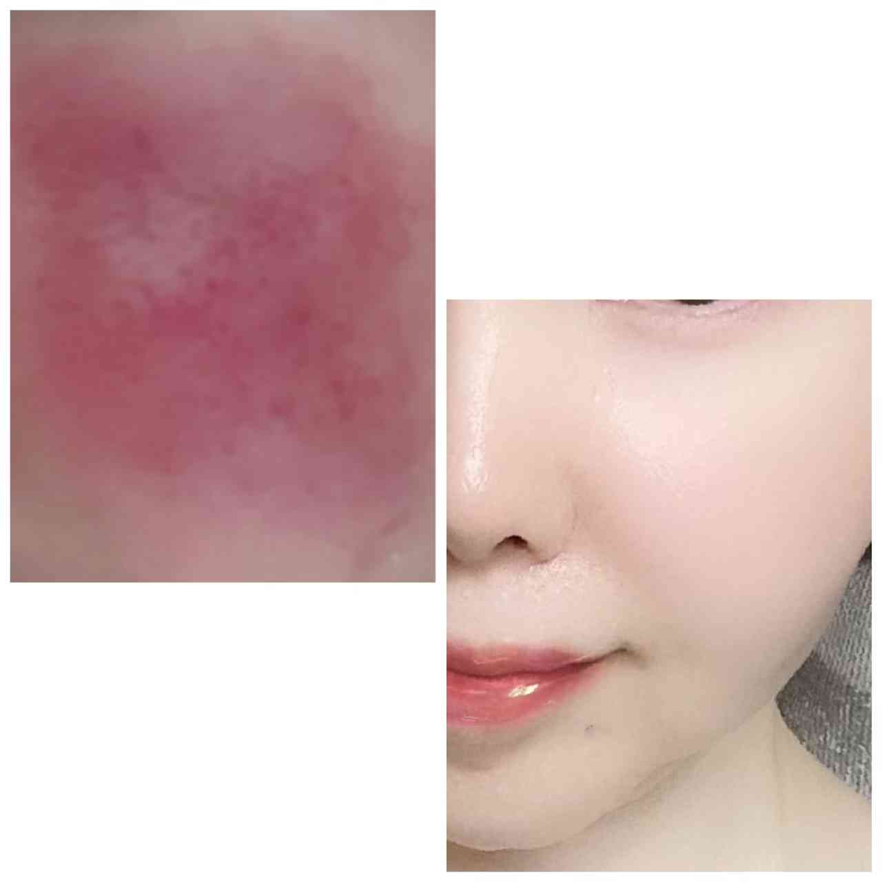 敏感肌のスキンケア
