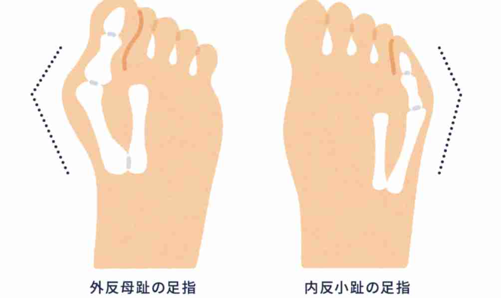 内反小趾を治したい！足が痛い！