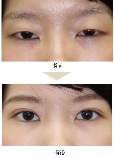  一重まぶたの方、集まれー！
