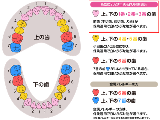 どれにする?銀歯、セラミック