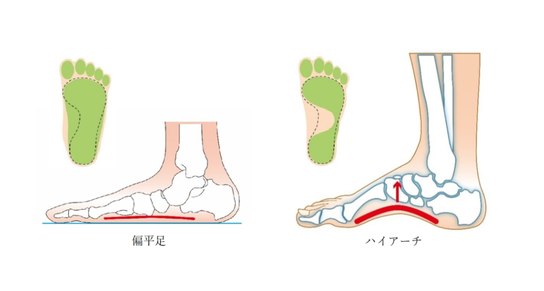 【情報交換の場】足底腱膜炎の人！