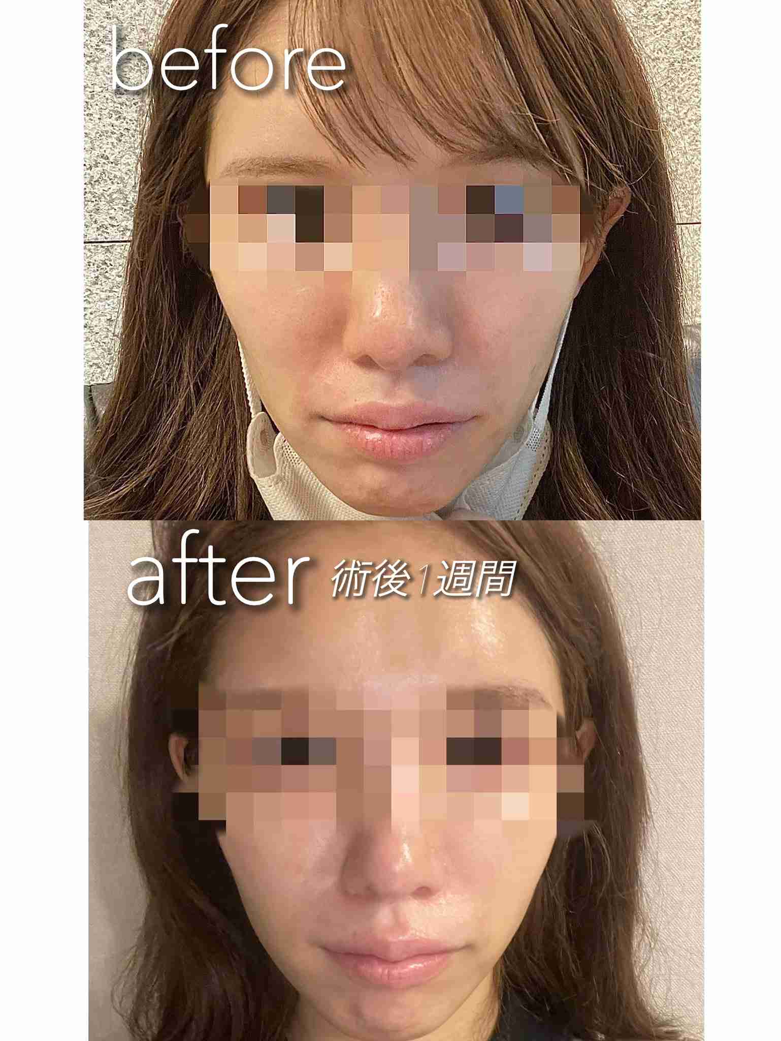 「整形して人生変わった」　人気インフルエンサーがビフォーアフター公開...激変ぶりにファン騒然「別人やん」