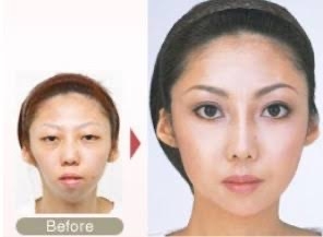 「整形して人生変わった」　人気インフルエンサーがビフォーアフター公開...激変ぶりにファン騒然「別人やん」
