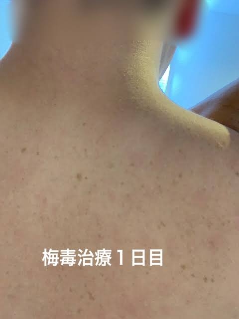 赤ちゃんの感染も…急増する梅毒「『遊んでいる人』だけの病気ではない」