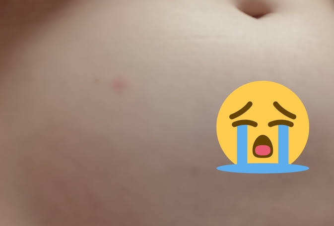 赤ちゃんの感染も…急増する梅毒「『遊んでいる人』だけの病気ではない」