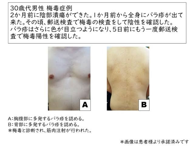 赤ちゃんの感染も…急増する梅毒「『遊んでいる人』だけの病気ではない」