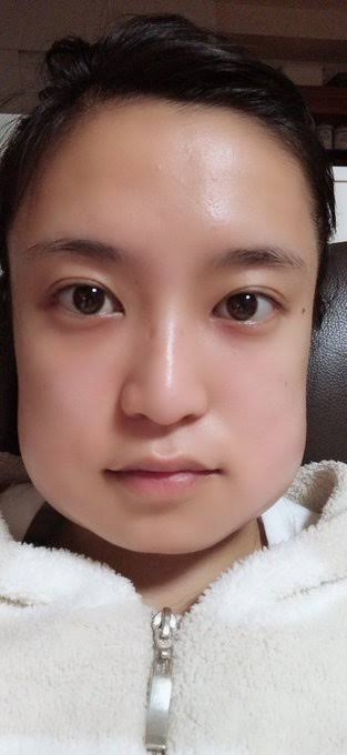 親知らず抜歯後の痛みの期間