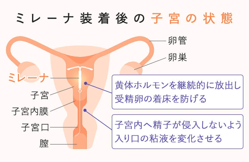 ミレーナ入れた人！