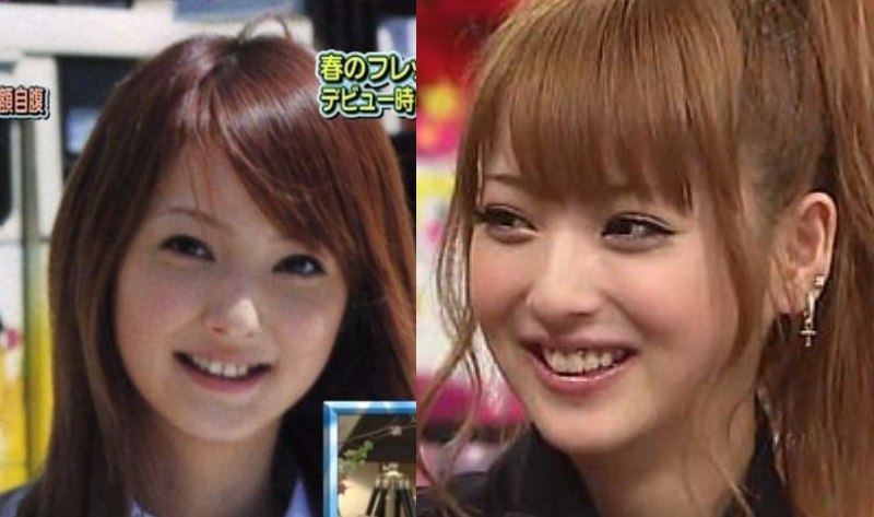 24歳の新婚ユーチューバー、家族で美容整形に「結婚式までにどうにかしないと」仕上がりに称賛の声