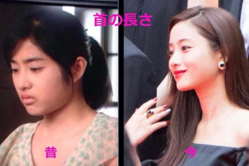 24歳の新婚ユーチューバー、家族で美容整形に「結婚式までにどうにかしないと」仕上がりに称賛の声
