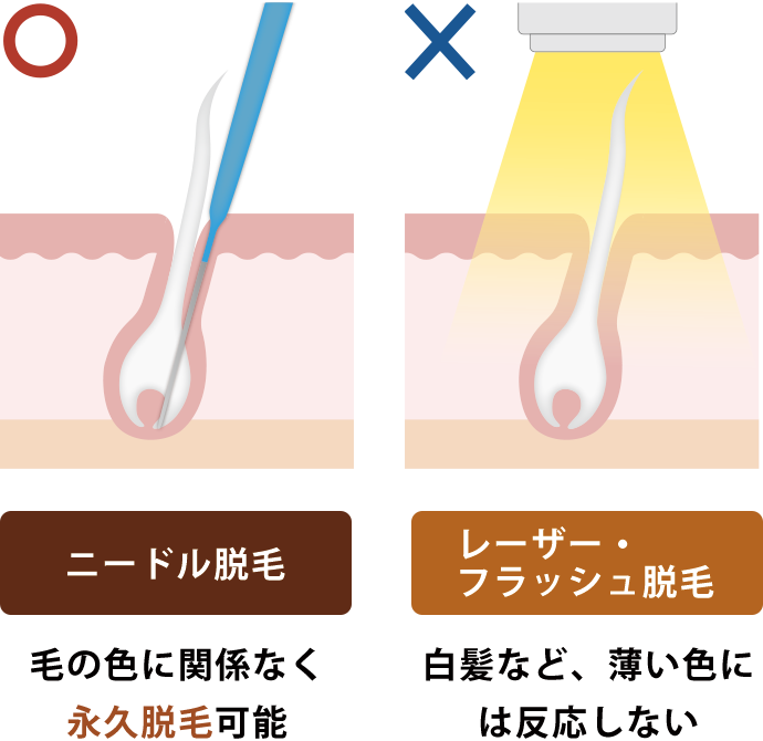 永久脱毛について語る