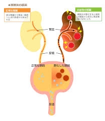 膀胱炎になりやすい