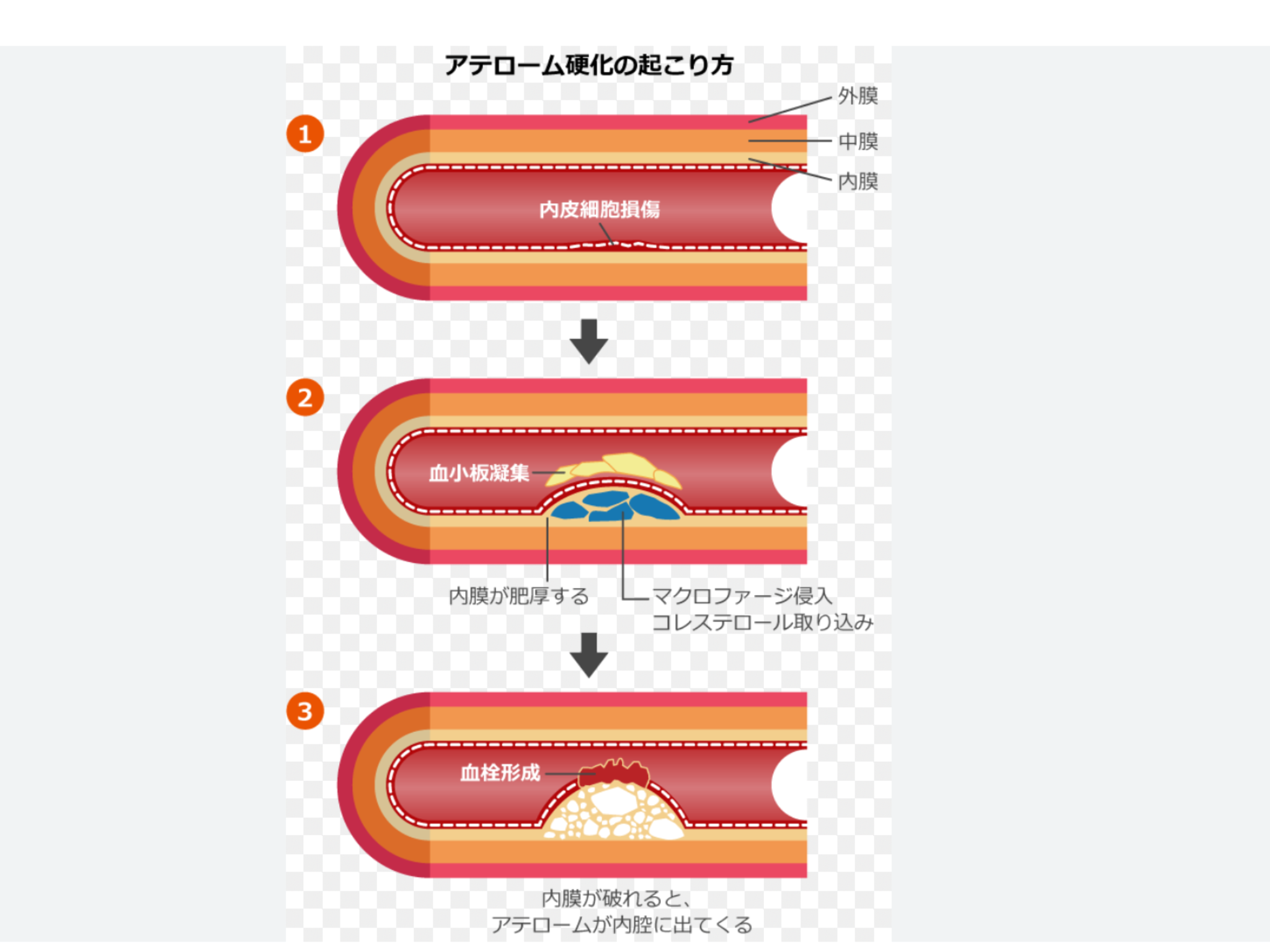 粉瘤、アテローム