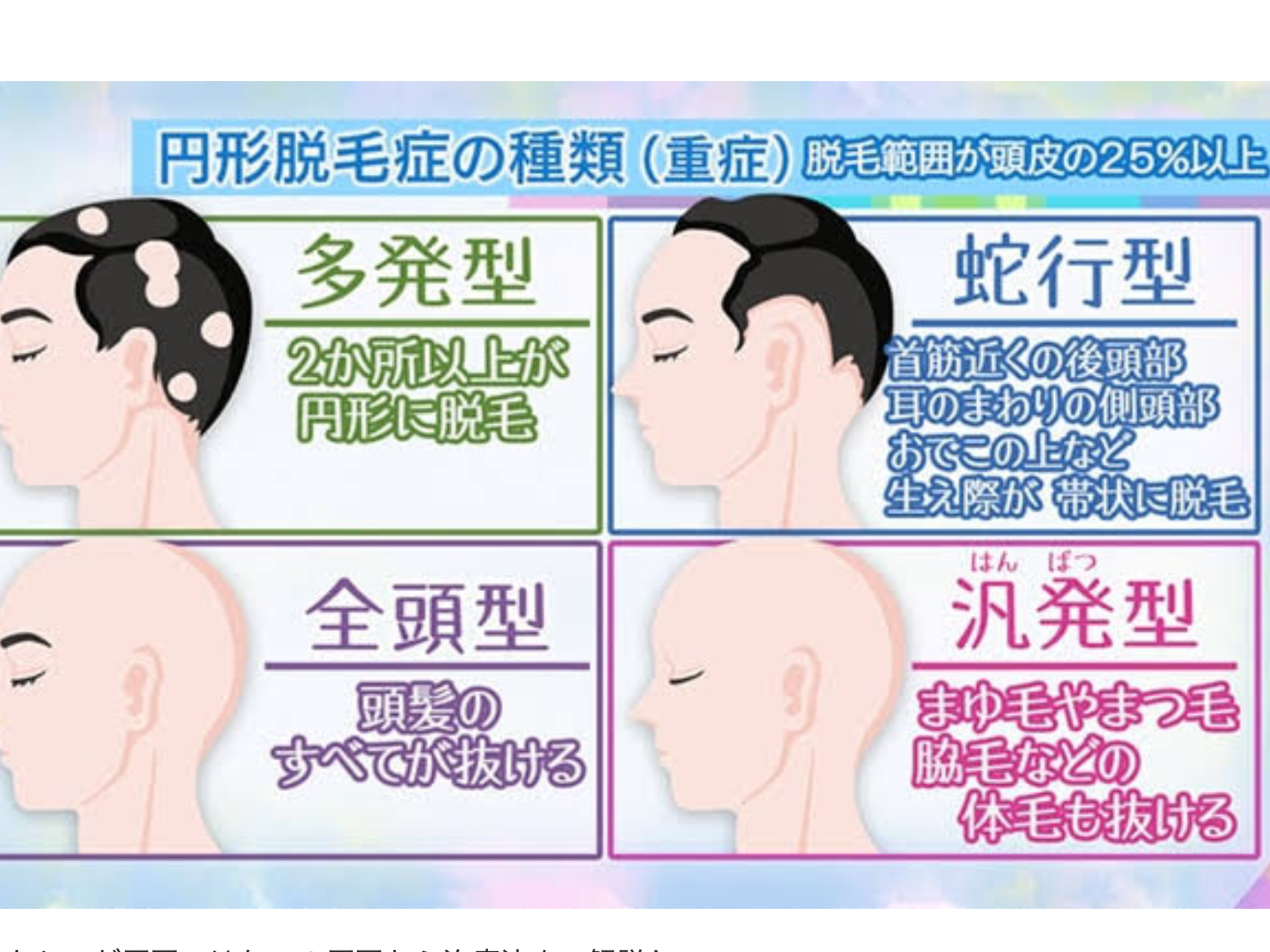 円形脱毛症になった