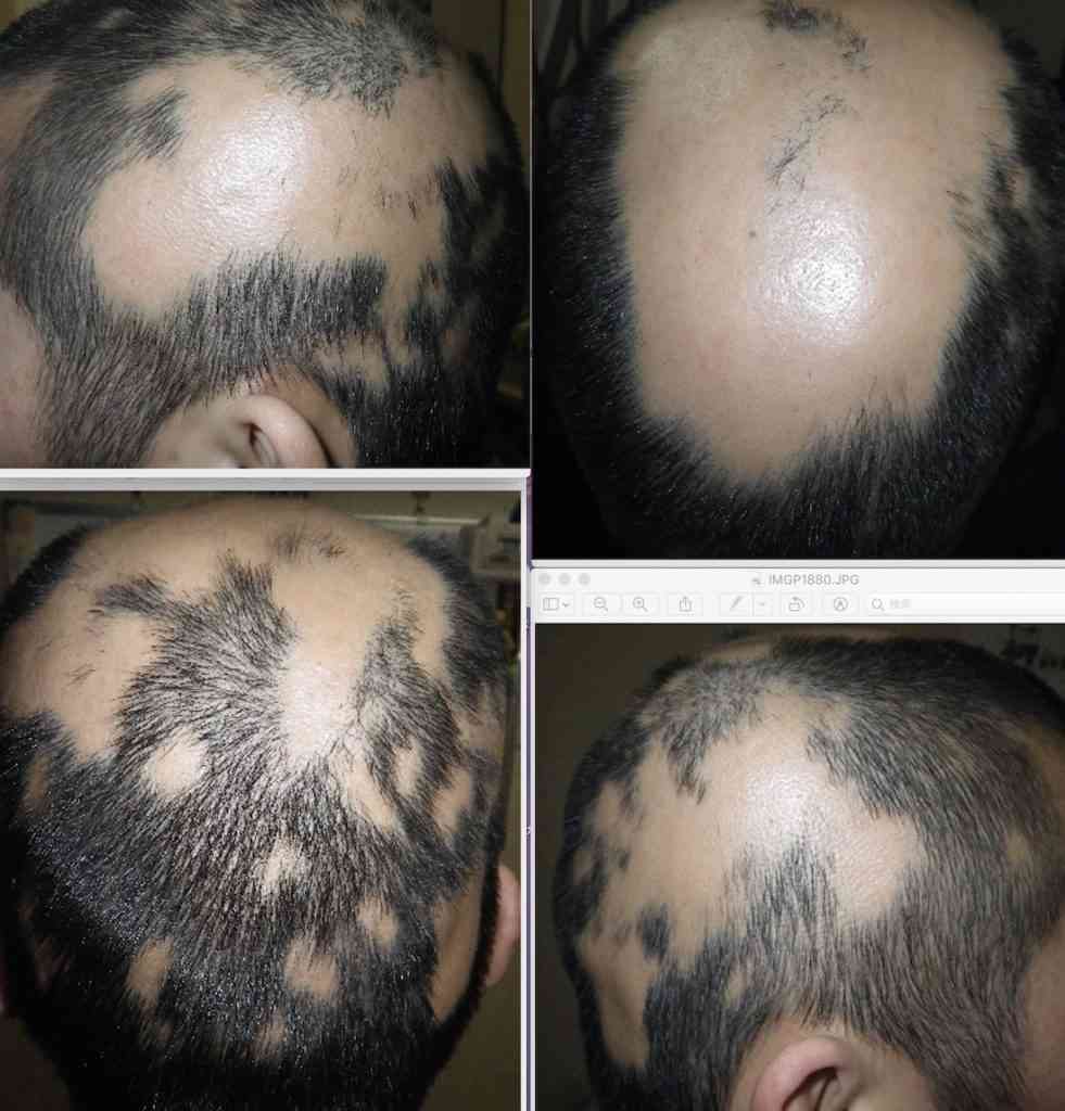 円形脱毛症になった