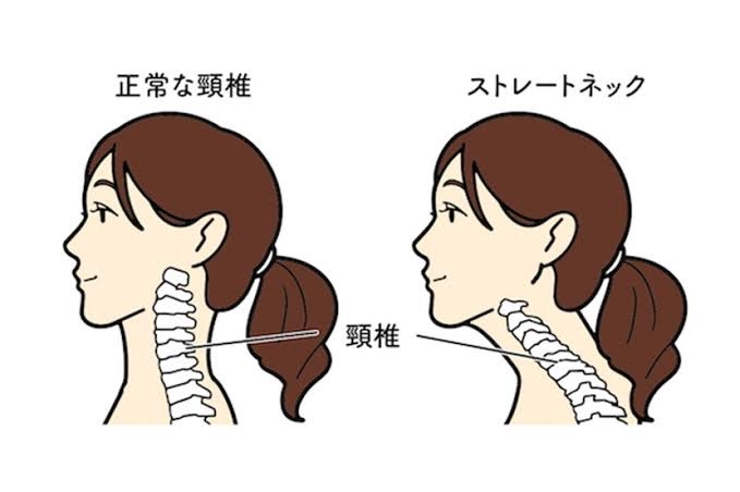 “寄り目”が固定する「急性スマホ内斜視」増加に警鐘　悪化すると歩くのも困難に