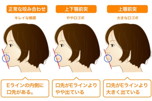 唇の形が悪い人【コンプレックス】