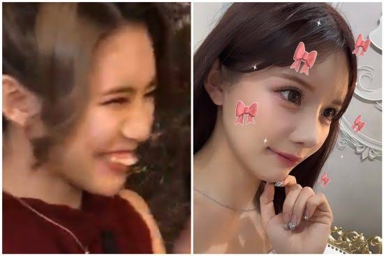 1千万整形のインフルエンサー　悲惨告白、アプリで会った男性がビフォー見て引く「整形ヤバい」→嘘ついて帰りブロック