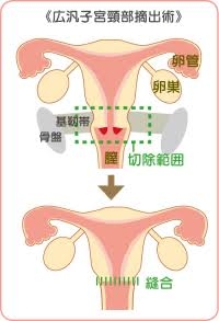 子宮頸がん「日本では増」…国立がんセンターがワクチン推進求める