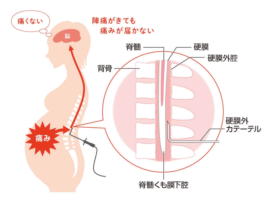 【経験談】無痛分娩【求む】