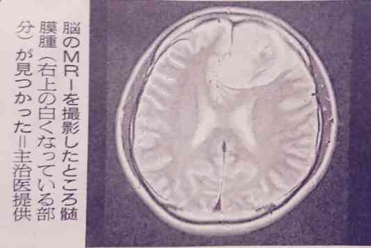 関ジャニ∞安田章大、髄膜腫の摘出手術後に変化 友人俳優から指摘される