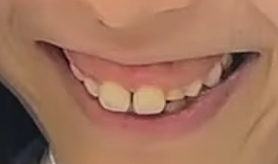 “出っ歯”や“ガチャ歯”がコンプレックスの対象に…子どもの歯科矯正は、何歳からやるべき？「乳歯での咬合誘導も1つの方法」