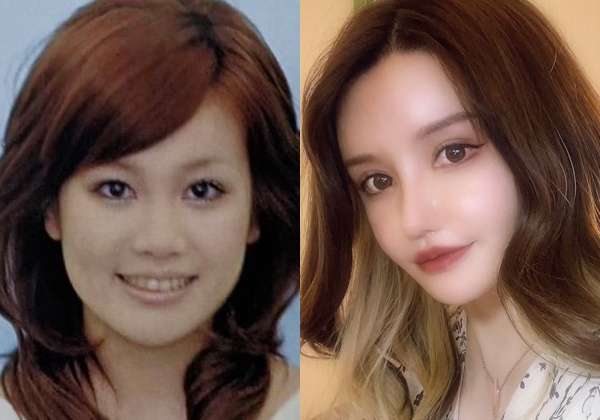 「整形前より醜くなった」と自信喪失…二重まぶたの手術を3回繰り返した女子大学生は身体醜形症になった