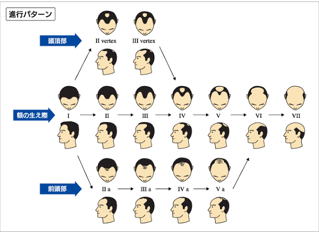 旦那さんや息子さんが薄毛治療している方いますか？