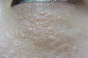 汗管腫をどうにかしたい