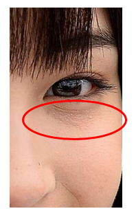 汗管腫をどうにかしたい