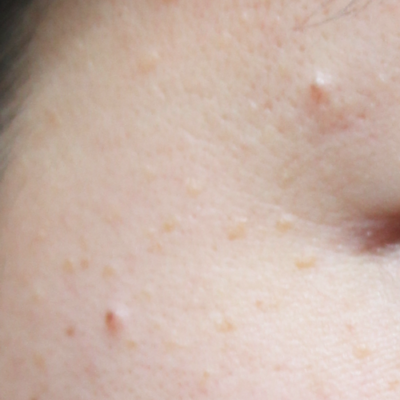 汗管腫をどうにかしたい