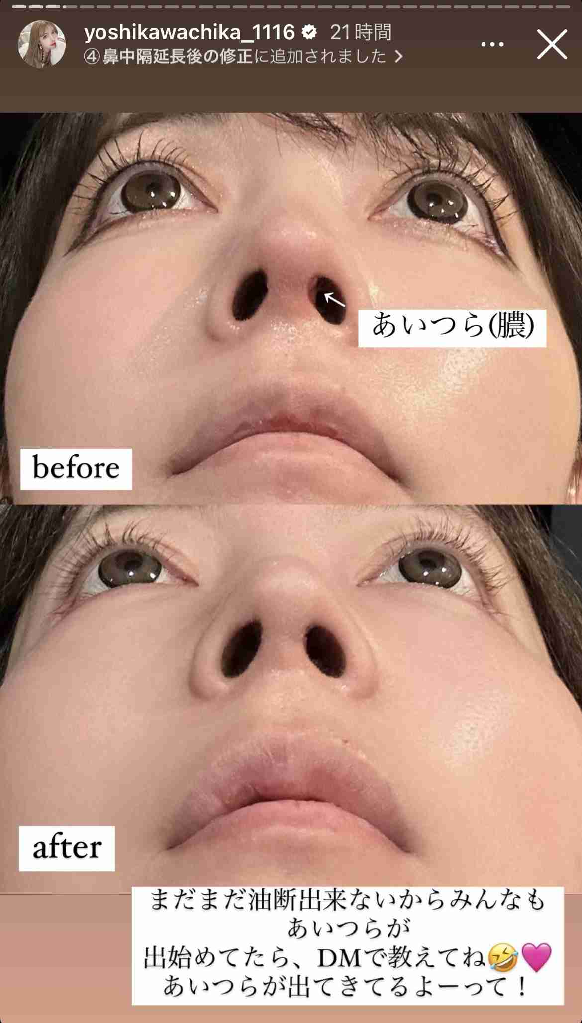 整形公表の双子モデル・吉川ちか、5度目の鼻の手術で「人生辛い」→「本当に辛い人に失礼」のコメントに反論「本音吐かせて」