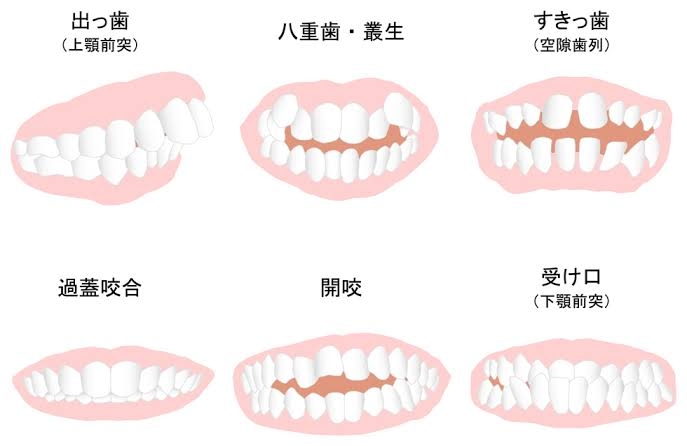 うそでしょ…「加齢とともに歯並びが悪くなる」ことがあるって本当なの? 歯科医師に聞いた