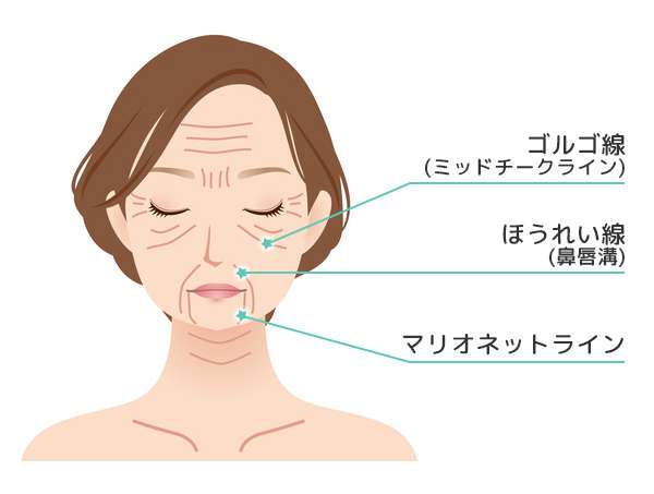 【助けて！】マリオネットラインがやばい
