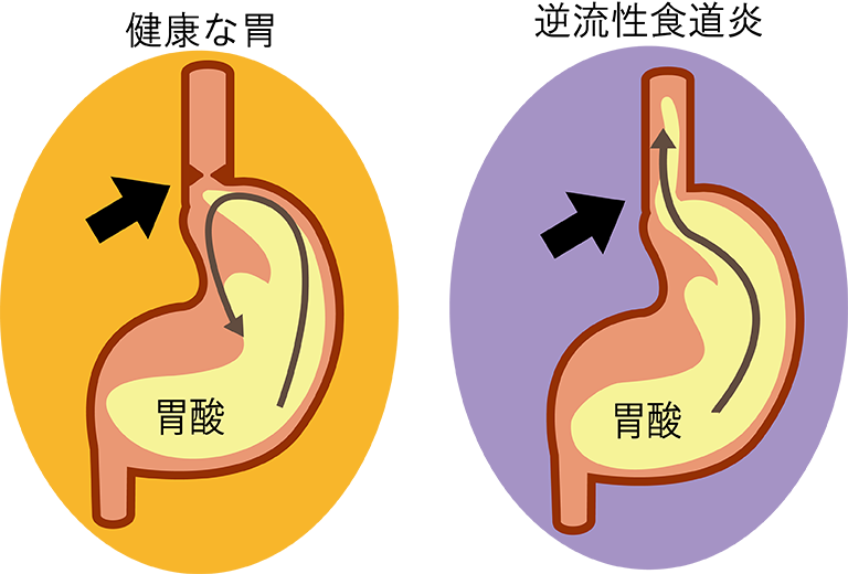 逆流性食道炎の方