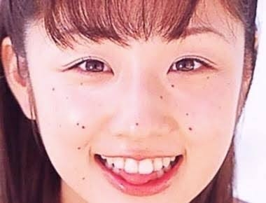 顔だけで100個近くのほくろに劣等感 探して、数えて、考えて…「醜いとしか思えなかった」