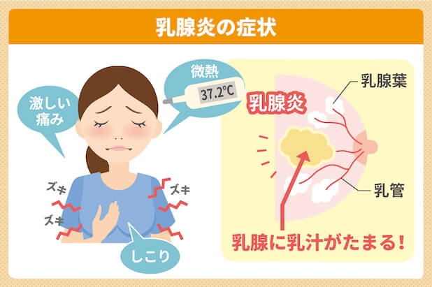乳腺炎について語るトピ