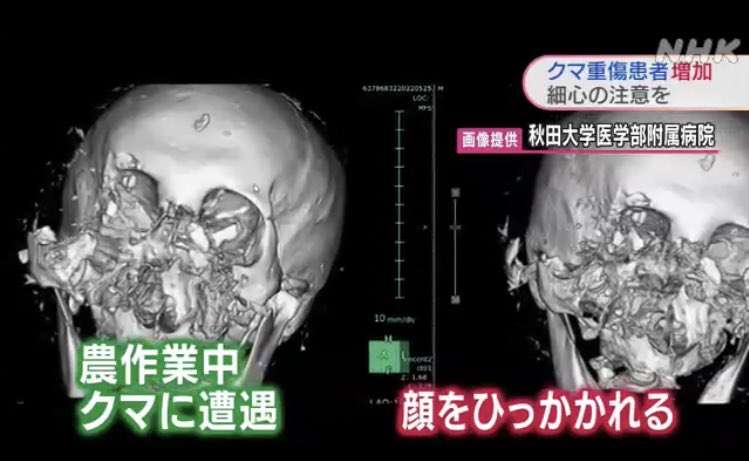 クマにひっかかれ、顔半分の皮がはがれ落ちる…被害の女性「鈴もスプレーも役に立たなかった」