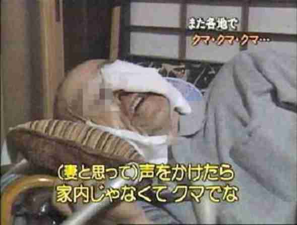 クマにひっかかれ、顔半分の皮がはがれ落ちる…被害の女性「鈴もスプレーも役に立たなかった」