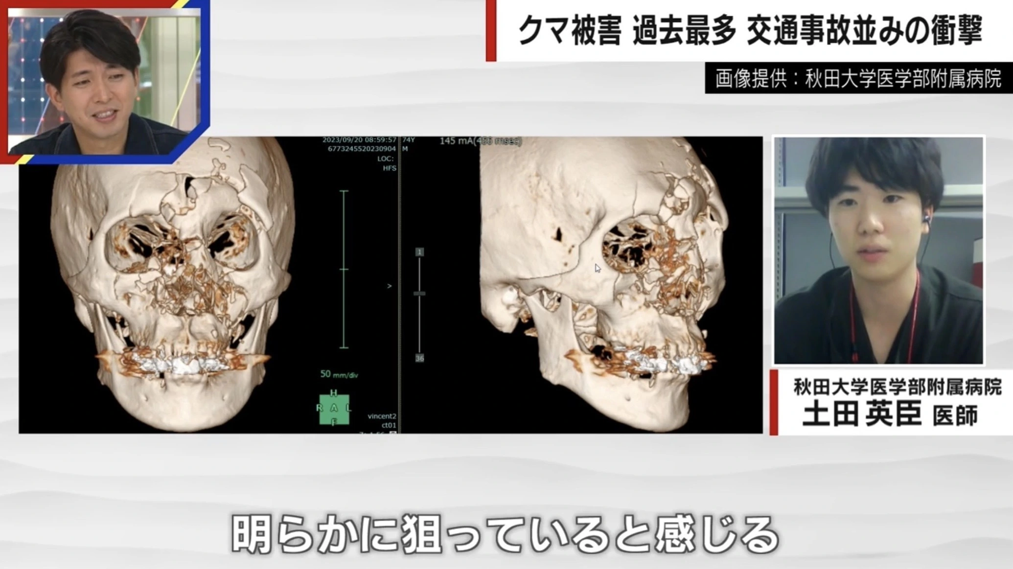 クマにひっかかれ、顔半分の皮がはがれ落ちる…被害の女性「鈴もスプレーも役に立たなかった」