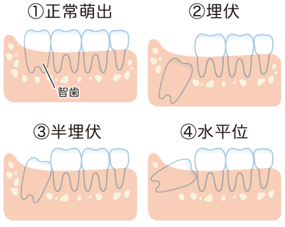 親知らず抜歯経験者教えて
