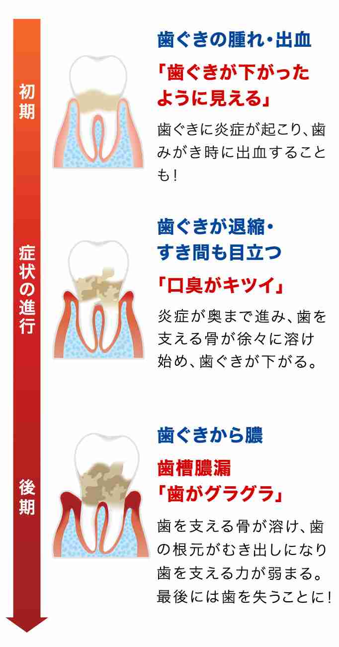 中〜重度の歯周病について
