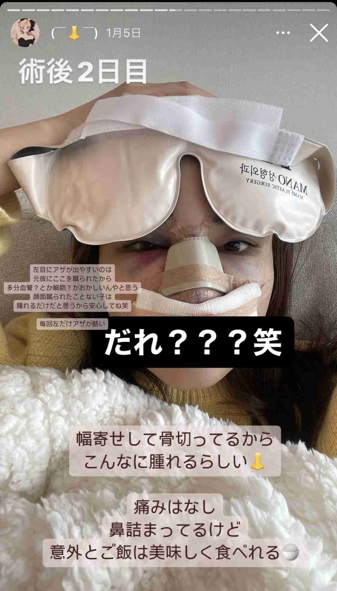 「殴られる様な人間なんでしょ？」顔に大アザもSNSで非難され...　人気インフルエンサー「まじ頭おかしくない？」