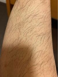 医療脱毛の痛み