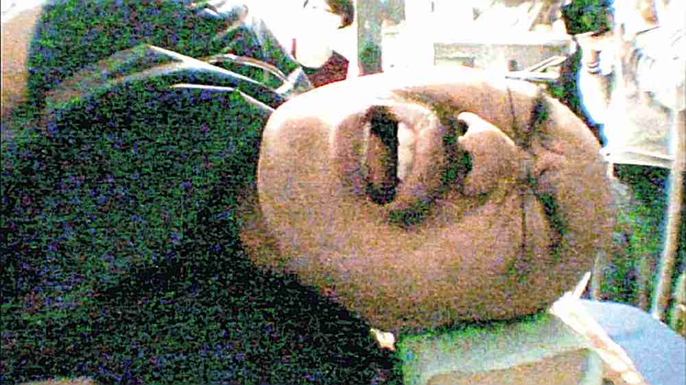 大腸カメラの挿入時の痛み