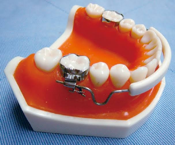 歯列矯正あるある